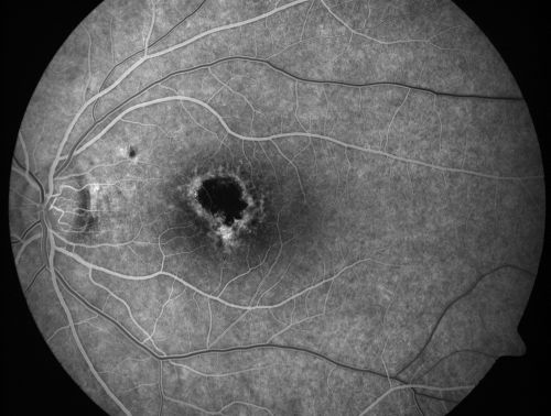 Toxoplasmosis Macular Scar (acquired not congenital) 31 Year Old Man- Recent Vision Change - Creeping Scar
31-year-old man had an episode of toxoplasmosis in the left eye, where unfortunately it adversely affected his central vision that was back in 2004 (7 years ago)
He did notice recently a change in his visual function.  He plays softball, he was getting hit by the ball and having trouble seeing and he said that is how he noticed the toxoplasmosis when it first occurred and he was concerned it might have recurred. 
OD 20/16,  OS 20/80. 
