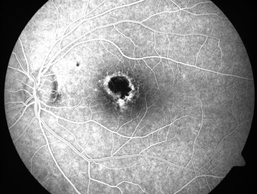 Toxoplasmosis Macular Scar (acquired not congenital) 31 Year Old Man- Recent Vision Change - Creeping Scar
31-year-old man had an episode of toxoplasmosis in the left eye, where unfortunately it adversely affected his central vision that was back in 2004 (7 years ago)
He did notice recently a change in his visual function.  He plays softball, he was getting hit by the ball and having trouble seeing and he said that is how he noticed the toxoplasmosis when it first occurred and he was concerned it might have recurred. 
OD 20/16,  OS 20/80. 
