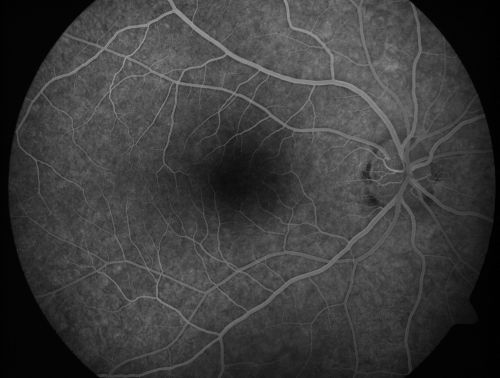 Toxoplasmosis Macular Scar (acquired not congenital) 31 Year Old Man- Recent Vision Change - Creeping Scar
31-year-old man had an episode of toxoplasmosis in the left eye, where unfortunately it adversely affected his central vision that was back in 2004 (7 years ago)
He did notice recently a change in his visual function.  He plays softball, he was getting hit by the ball and having trouble seeing and he said that is how he noticed the toxoplasmosis when it first occurred and he was concerned it might have recurred. 
OD 20/16,  OS 20/80. 
