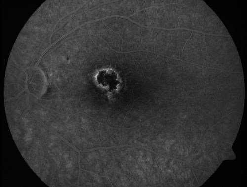 Toxoplasmosis Macular Scar (acquired not congenital) 31 Year Old Man- Recent Vision Change - Creeping Scar
31-year-old man had an episode of toxoplasmosis in the left eye, where unfortunately it adversely affected his central vision that was back in 2004 (7 years ago)
He did notice recently a change in his visual function.  He plays softball, he was getting hit by the ball and having trouble seeing and he said that is how he noticed the toxoplasmosis when it first occurred and he was concerned it might have recurred. 
OD 20/16,  OS 20/80. 
