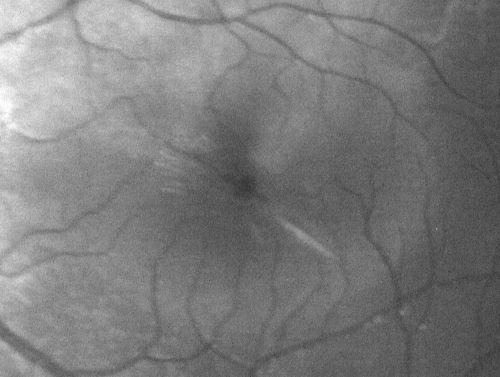 Macular Hole - Traumatic - 11 year old boy (also retinal whitening Berlins Edema)
11-year-old boy with a history of blunt trauma to the left eye yesterday.  He reports he lost vision immediately but it has gotten somewhat better.  He reports he sees â€œred streamersâ€ and he has very blurry visual acuity., 20/200 OS
