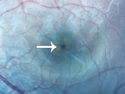 Macular Hole - Traumatic - 11 year old boy (also retinal whitening Berlins Edema)
11-year-old boy with a history of blunt trauma to the left eye yesterday.  He reports he lost vision immediately but it has gotten somewhat better.  He reports he sees â€œred streamersâ€ and he has very blurry visual acuity., 20/200 OS
