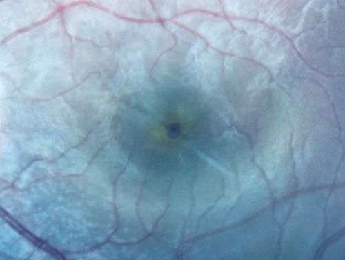 Macular Hole - Traumatic - 11 year old boy (also retinal whitening Berlins Edema)
11-year-old boy with a history of blunt trauma to the left eye yesterday.  He reports he lost vision immediately but it has gotten somewhat better.  He reports he sees â€œred streamersâ€ and he has very blurry visual acuity., 20/200 OS
