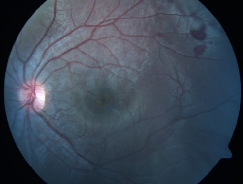 Macular Hole - Traumatic - 11 year old boy (also retinal whitening Berlins Edema)
11-year-old boy with a history of blunt trauma to the left eye yesterday.  He reports he lost vision immediately but it has gotten somewhat better.  He reports he sees â€œred streamersâ€ and he has very blurry visual acuity., 20/200 OS
