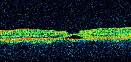 Macular Hole - Traumatic - 11 year old boy (also retinal whitening Berlins Edema)
11-year-old boy with a history of blunt trauma to the left eye yesterday.  He reports he lost vision immediately but it has gotten somewhat better.  He reports he sees â€œred streamersâ€ and he has very blurry visual acuity., 20/200 OS
