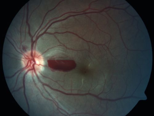 Traumatic Macular Hole and Pre-retinal Hemorrhage - Assault
This 18 year old male was assaulted on 3 weeks ago and seen in the emergency room for that.  He returns today reporting his left eye is getting better and is not quite as blurry. VA 20/60 (uncorrected)

