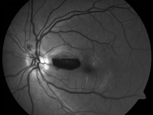 Traumatic Macular Hole and Pre-retinal Hemorrhage - Assault
This 18 year old male was assaulted on 3 weeks ago and seen in the emergency room for that.  He returns today reporting his left eye is getting better and is not quite as blurry. VA 20/60 (uncorrected)
