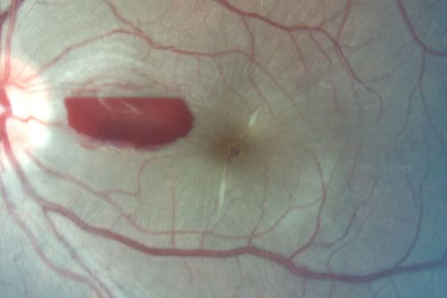 Traumatic Macular Hole and Pre-retinal Hemorrhage - Assault
This 18 year old male was assaulted on 3 weeks ago and seen in the emergency room for that.  He returns today reporting his left eye is getting better and is not quite as blurry. VA 20/60 (uncorrected)
