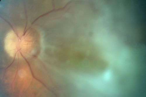 Chronic Macula-off Tractional Retinal Detachment Left Eye Proliferative Diabetic Retinopathy
81-year-old man with diabetes for 24 years has proliferative diabetic retinopathy in both eyes with a chronic tractional retinal detachment in the left eye 4 years old. OD is 20/40, OS is 2/200
