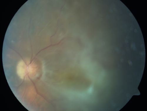 Chronic Macula-off Tractional Retinal Detachment Left Eye Proliferative Diabetic Retinopathy
81-year-old man with diabetes for 24 years has proliferative diabetic retinopathy in both eyes with a chronic tractional retinal detachment in the left eye 4 years old. OD is 20/40, OS is 2/200
