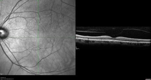 Lung Cancer Metastasis to Right Eye
63 year old female with vision loss for 6 weeks.  She had been scheduled for cataract surgery and then a tumor was found.  She was ultimately diagnosed with lung cancer.  Vision is 20/100
