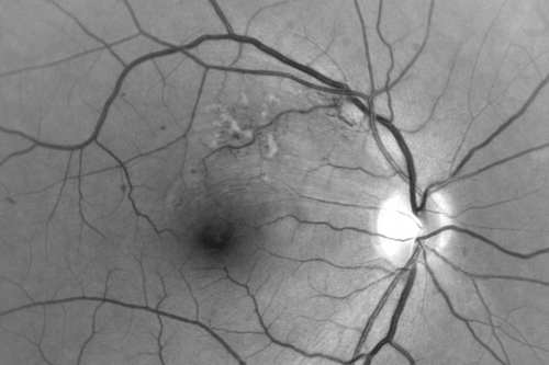 Twig Branch Retinal Vein Occlusion - Recurrent Macular Edema with extended interval Lucentis Therapy after first 6 monthly Injections
39-year-old man has a macular branch retinal vein occlusion with macular edema.  He had an excellent response to Lucentis for his first 6 treatments.  He was last here 6 weeks ago and his vision seems OK to him.  OD 20/40. 
