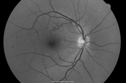 Twig Branch Retinal Vein Occlusion - Recurrent Macular Edema with extended interval Lucentis Therapy after first 6 monthly Injections
39-year-old man has a macular branch retinal vein occlusion with macular edema.  He had an excellent response to Lucentis for his first 6 treatments.  He was last here 6 weeks ago and his vision seems OK to him.  OD 20/40. 
