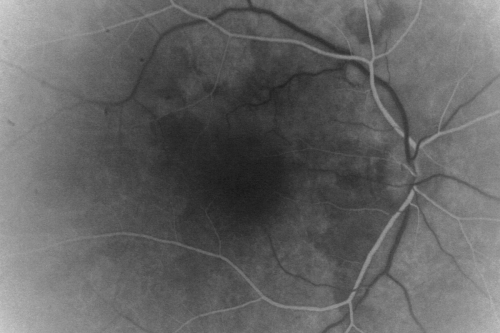 Twig Branch Retinal Vein Occlusion - Recurrent Macular Edema with extended interval Lucentis Therapy after first 6 monthly Injections
39-year-old man has a macular branch retinal vein occlusion with macular edema.  He had an excellent response to Lucentis for his first 6 treatments.  He was last here 6 weeks ago and his vision seems OK to him.  OD 20/40. 
