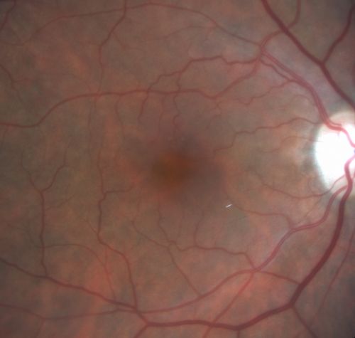 Old BRAO twig with plaque
81-year-old woman  Her left eye is amblyopic.  Her right eye was doing fine until about last Sunday, which is five days ago.  She had a change in vision where for five minutes she saw a shadow in her side vision out of the right eye.  She describes it as being more up into the left.  It lasted for just a brief time and then went away. She has had atrial fibrillation since January of 2008.  She is on Coumadin for that.  She is diabetic for eleven years.  OD is 20/25, OS is 20/60.  IOP:  OD 15, OS 18. 
Keywords: brao;twig;plaque