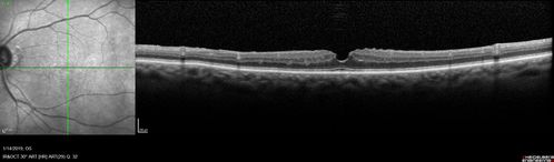 Twig Old  Macular Branch Retinal Vein Occlusion - Venous Venous Collaterals
88 year old man with 20/25 vision in his left and only eye.  There is vascular remodeling consistent with an old twig BRVO.
