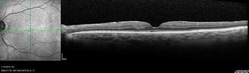Twig Old  Macular Branch Retinal Vein Occlusion - Venous Venous Collaterals
88 year old man with 20/25 vision in his left and only eye.  There is vascular remodeling consistent with an old twig BRVO.
