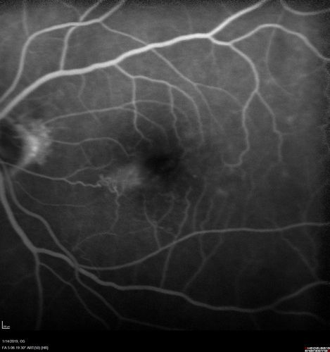 Twig Old  Macular Branch Retinal Vein Occlusion - Venous Venous Collaterals
88 year old man with 20/25 vision in his left and only eye.  There is vascular remodeling consistent with an old twig BRVO.
