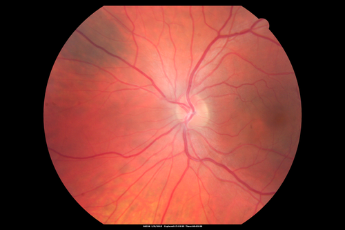 Unilateral Acute Idiopathic Maculopathy (UAIM)

