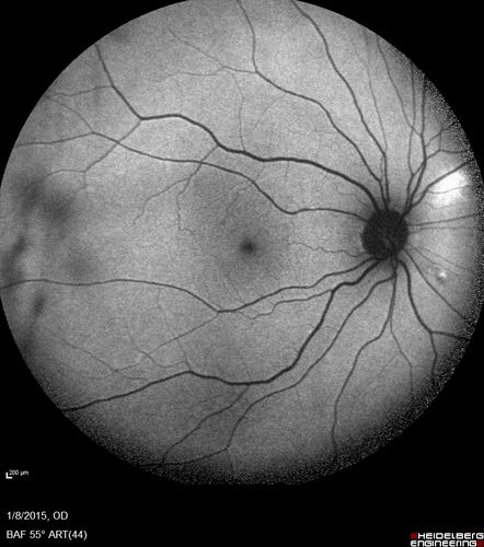 Unilateral Acute Idiopathic Maculopathy (UAIM)
