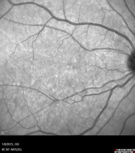 Unilateral Acute Idiopathic Maculopathy (UAIM)
