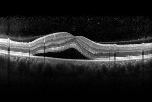 Unilateral Acute Idiopathic Maculopathy (UAIM)
41 year old with serous retinal detachment OS and sudden vision loss.  He had a viral prodrome.  Coxscackie IgG was high but no acute infection was documented.  Vision improved in about 2 months without therapy.
