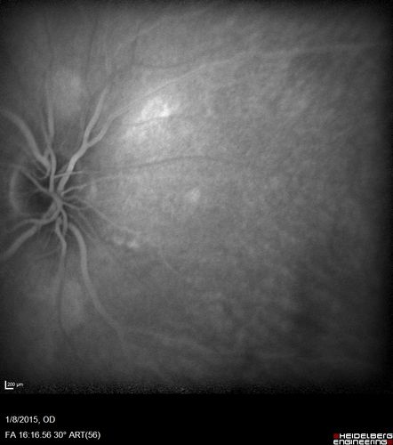 Unilateral Acute Idiopathic Maculopathy (UAIM)
41 year old with serous retinal detachment OS and sudden vision loss.  He had a viral prodrome.  Coxscackie IgG was high but no acute infection was documented.  Vision improved in about 2 months without therapy. - Right eye has spot nasal to the optic nerve
