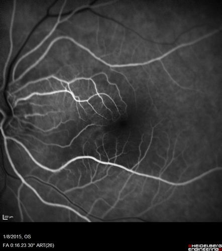 Unilateral Acute Idiopathic Maculopathy (UAIM)
41 year old with serous retinal detachment OS and sudden vision loss.  He had a viral prodrome.  Coxscackie IgG was high but no acute infection was documented.  Vision improved in about 2 months without therapy. - Right eye has spot nasal to the optic nerve
