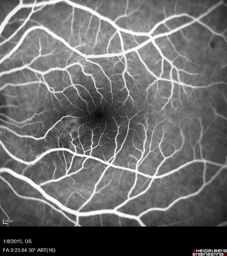 Unilateral Acute Idiopathic Maculopathy (UAIM)
41 year old with serous retinal detachment OS and sudden vision loss.  He had a viral prodrome.  Coxscackie IgG was high but no acute infection was documented.  Vision improved in about 2 months without therapy. - Right eye has spot nasal to the optic nerve
