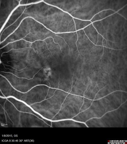 Unilateral Acute Idiopathic Maculopathy (UAIM)
41 year old with serous retinal detachment OS and sudden vision loss.  He had a viral prodrome.  Coxscackie IgG was high but no acute infection was documented.  Vision improved in about 2 months without therapy. - Right eye has spot nasal to the optic nerve
