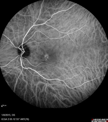 Unilateral Acute Idiopathic Maculopathy (UAIM)
41 year old with serous retinal detachment OS and sudden vision loss.  He had a viral prodrome.  Coxscackie IgG was high but no acute infection was documented.  Vision improved in about 2 months without therapy. - Right eye has spot nasal to the optic nerve
