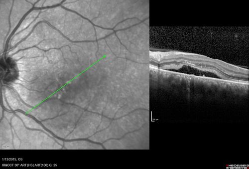 Unilateral Acute Idiopathic Maculopathy (UAIM)
1 week later eye looks better (after initial scan)  41 year old with serous retinal detachment OS and sudden vision loss.  He had a viral prodrome.  Coxscackie IgG was high but no acute infection was documented.  Vision improved in about 2 months without therapy. - Right eye has spot nasal to the optic nerve
