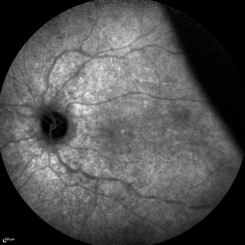 Choroidal Effusions and Serous retinal detachment with Systemic Testosterone and Cialis in 75 year old Man
IR shows choroidal effusion as black (confocal system)
