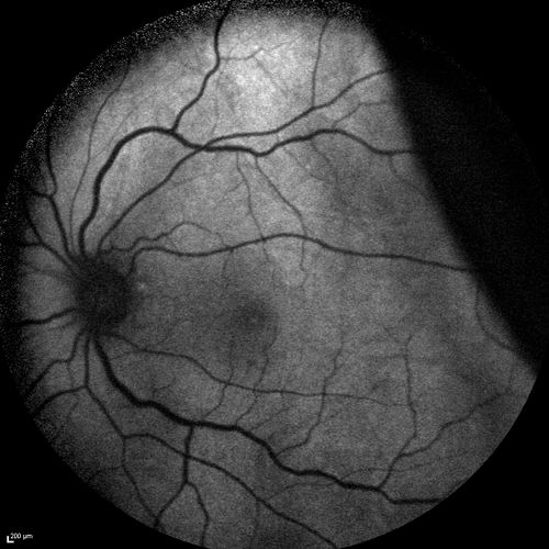 Choroidal Effusions and Serous retinal detachment with Systemic Testosterone and Cialis in 75 year old Man
FAF shows choroidal effusion as black (confocal system)
