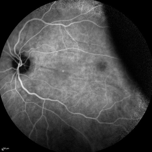 Choroidal Effusions and Serous retinal detachment with Systemic Testosterone and Cialis in 75 year old Man
Fluorescein angiogram shows some staining of the disk - confocal system renders peripheral effusions black
