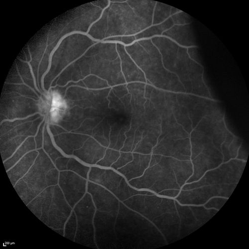 Choroidal Effusions and Serous retinal detachment with Systemic Testosterone and Cialis in 75 year old Man
Fluorescein angiogram shows some staining of the disk - confocal system renders peripheral effusions black

