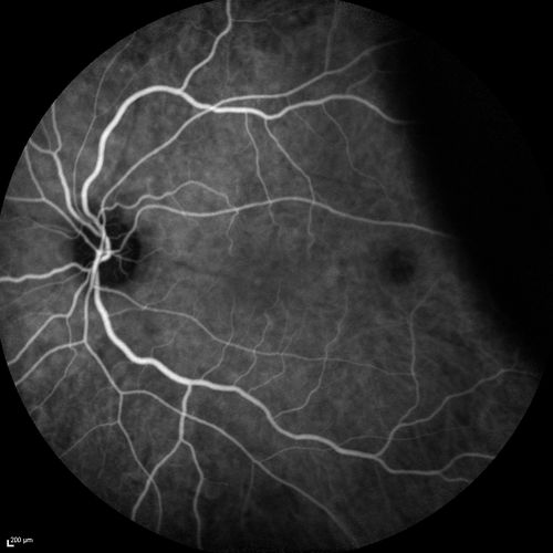 Choroidal Effusions and Serous retinal detachment with Systemic Testosterone and Cialis in 75 year old Man
Fluorescein angiogram shows some staining of the disk - confocal system renders peripheral effusions black

