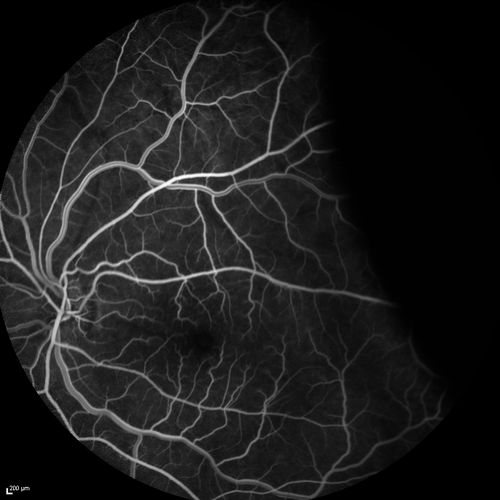 Choroidal Effusions and Serous retinal detachment with Systemic Testosterone and Cialis in 75 year old Man
Fluorescein angiogram shows some staining of the disk - confocal system renders peripheral effusions black
