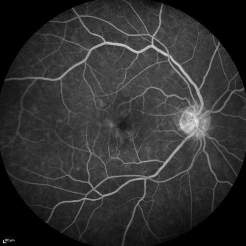 Choroidal Effusions and Serous retinal detachment with Systemic Testosterone and Cialis in 75 year old Man
Fluorescein angiogram shows some staining of the disk
