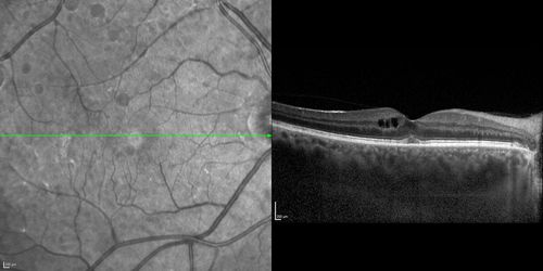 Choroidal Effusions and Serous retinal detachment with Systemic Testosterone and Cialis in 75 year old Man
1 month following presentation, the eyes look better and vision is a little better
