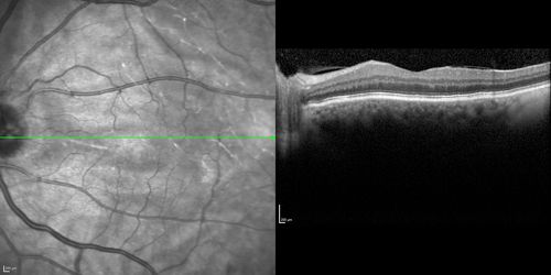Choroidal Effusions and Serous retinal detachment with Systemic Testosterone and Cialis in 75 year old Man
2 months following presentation, vision is better, 20/40 OU
