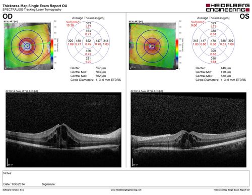 Uveitis and Cystoid Macular Edema - Probably Sarcoidosis - SD OCT Map
VA 20/63 OD 20/50 OS - 3 months vision loss - second episode by history of uveitis
