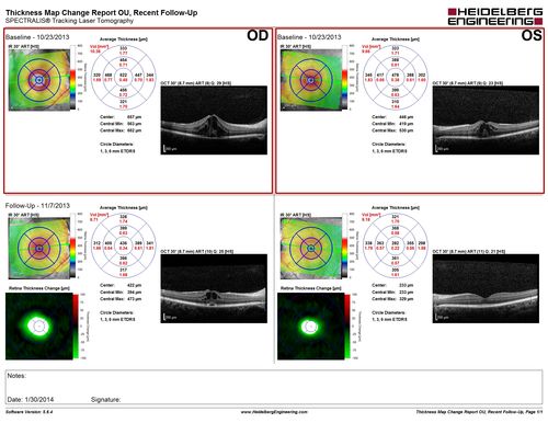 Uveitis and Cystoid Macular Edema - Probably Sarcoidosis 
- Decreased CME after topical Pred Forte for one month QID Vision 20/40 OD, 20/25 OS

