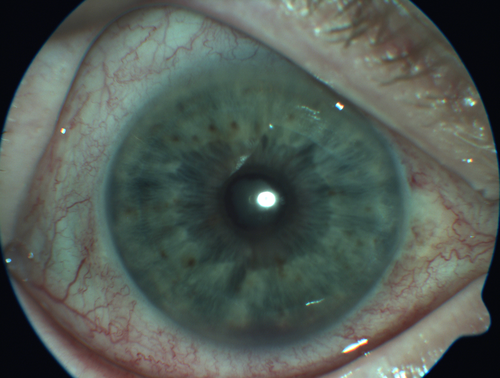 Anterior Uveitis Vemurafenib - Zelboraf
60 year old man on 8 years of vemurafenib with 4 days of pain and floaters - images show 360 degree synechia.  There is an iris nodule not visible
