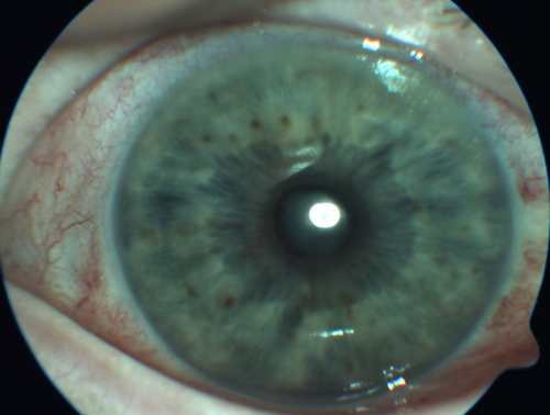 Anterior Uveitis Vemurafenib - Zelboraf
60 year old man on 8 years of vemurafenib with 4 days of pain and floaters - images show 360 degree synechia.  There is an iris nodule not visible
