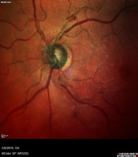 Venous Anomaly - 80 year old female - normal vision
