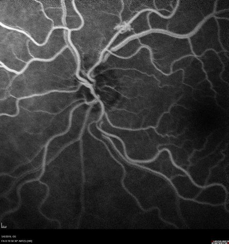 Venous Anomaly - 80 year old female - normal vision
