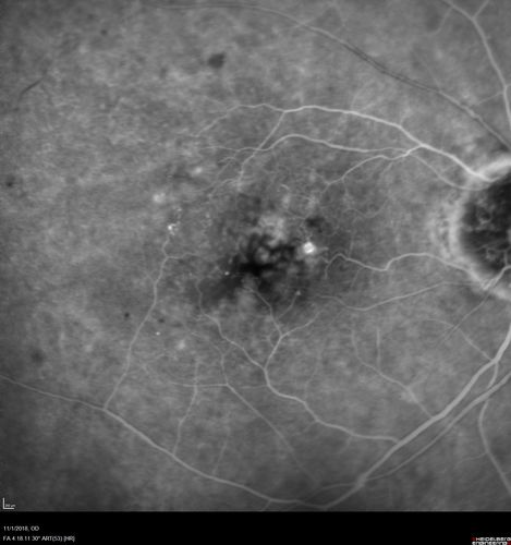 Venous Macroaneurysm 6 year old CRVO - treated with focal laser
93 year old female with CRVO in the right eye 6 years ago.  The visual potential is 20/100 and has recently subjectively and objectively declined.  VA is 20/200 and she has new onset macular edema from a venous macroaneurysm that formed at a collateral vessel.  This responded nicely to a single laser spot.

