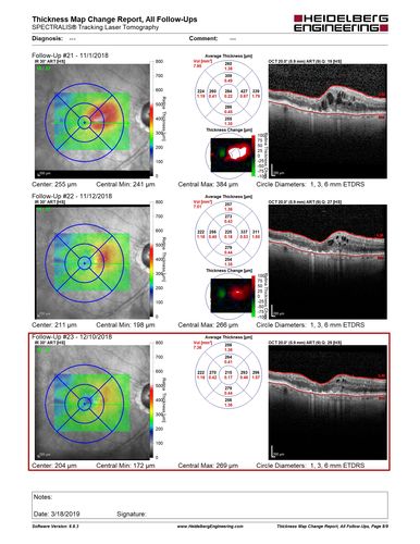 Venous Macroaneurysm 6 year old CRVO - treated with focal laser
93 year old female with CRVO in the right eye 6 years ago.  The visual potential is 20/100 and has recently subjectively and objectively declined.  VA is 20/200 and she has new onset macular edema from a venous macroaneurysm that formed at a collateral vessel.  This responded nicely to a single laser spot.
