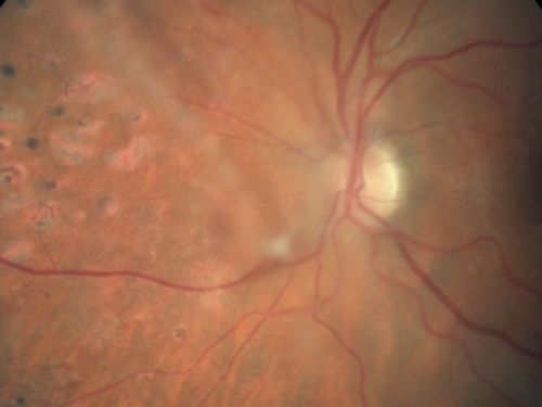 Regressed Proliferative Diabetic Retinopathy with Recurrent Vitreous Hemorrhage from Vitreoretinal Traction over a Major Retinal Vessel (Vein)
56-year-old woman has had recurrent vitreous hemorrhage in the left eye from vitreoretinal traction. Diabetes Mellitus for 20 years and excellent response to vitrectomy in the right eye about 1 year ago for recurrent vitreous hemorrhage from traction over a major retinal vessel.

VISUAL ACUITY:  Vision OS is 20/200
